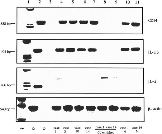 Fig. 8. RT-PCR analysis of CD14, IL-15, IL-2, and control β-actin mRNA in GL from 4 LDGL patients. Lane 1, molecular weight marker (φ174 Hae-digested); lane 2, control PBMC stimulated for 12 hours with PHA (5 μg/mL) (positive control); lane 3, negative control (sample without cDNA); lanes 4 and 5, 2 CD3+ LDGL cases (cases no. 1 and 3 in Table 1); lanes 6 and 7, 2 CD3− LDGL (cases no. 10 and 14 in Table 1); lanes 8 and 9, highly enriched GL from cases no. 1 and 14; lanes 10 and 11, enriched peripheral blood monocytes of cases no. 1 and no. 14.