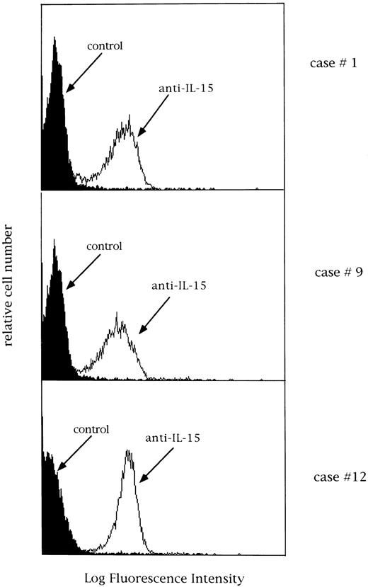 Fig. 9. Expression of IL-15 on 3 different LDGL patients (cases no. 1, 9, and 12 in Table 1). Control histograms (indicated by filled areas) were overlayed on histograms of patients' cells stained with a rabbit anti–15 antibody.