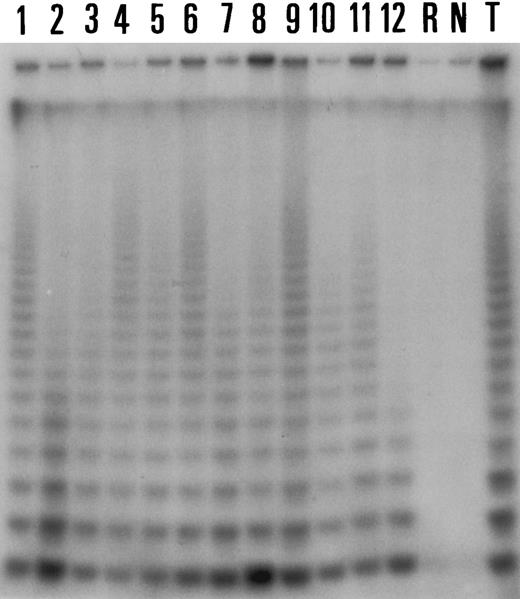 Fig. 2. Comparison of the results of the TRAP assay in six cases of NHLs (lanes 1 through 6) and in six reactive hyperplastic lymph nodes (lanes 7 through 12). Note that all cases have similar levels of telomerase activity. Lane T is a positive control (Val cell line). Lane R corresponds to RNase A pretreated sample from the Val cell line and lane N corresponds to a negative control (without CHAPS extracts).