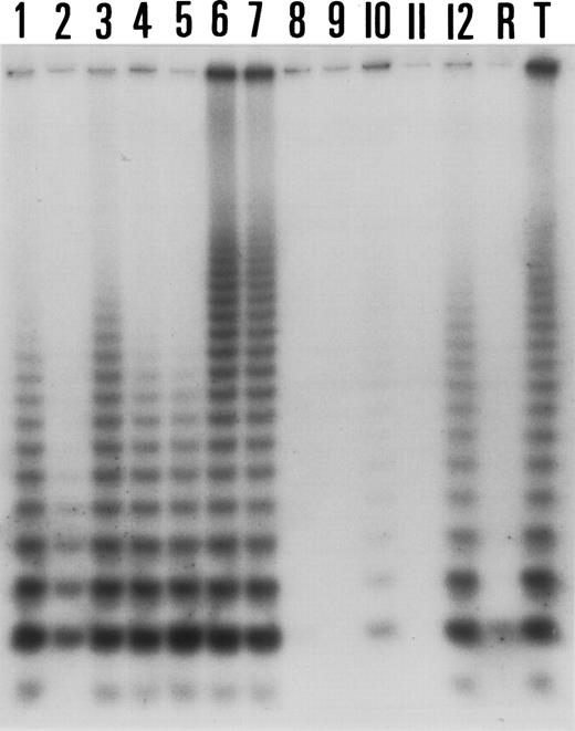 Fig. 3. Comparison of telomerase activity in hyperplastic tonsils (lanes 1 through 5), NHLs (lanes 6, 7, 10 through 12), and HD (lanes 8 and 9). The case of NHL (lane 11) and the two cases of HD (lanes 8 and 9) are clearly negative. Lane T corresponds to a positive control (Val cell line). Lane R corresponds to RNase A pretreated sample from the Val cell line.