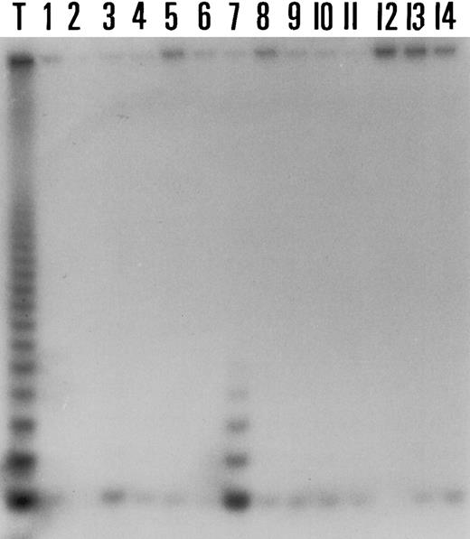 Fig. 4. Results of the telomerase activity in 14 cases of HD. Case 7 is weakly but undoubtedly positive. Lane T corresponds to the positive control (Val cell line).