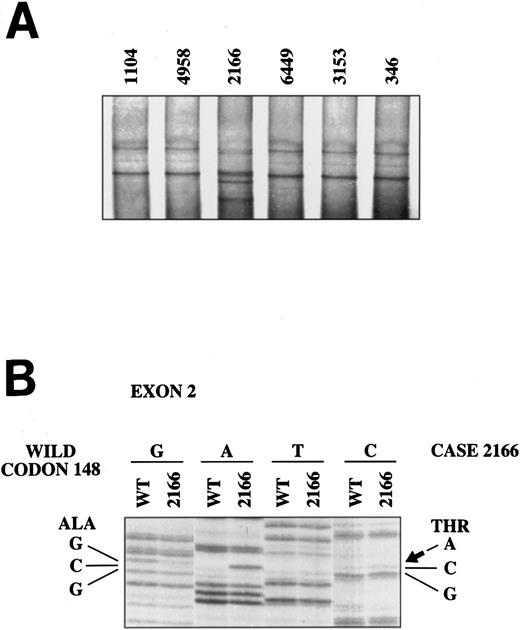 Fig. 2. SSCP analysis of p16INK4a exon 2. The abnormal mobility observed in the typical mantle cell lymphoma 2166 (A) is the result of the known polymorphism in codon 148 with the change GCG (alanine) → ACG (threonine) (B).