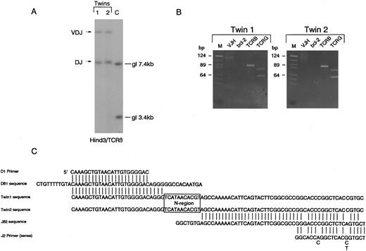 Fig. 1. Identical rearrangements of T-cell receptor genes in concordant twin T-cell malignancy. (A) Southern blot analysis of TCRβ rearrangements showing shared bi-allelic rearrangements (same sized restriction fragments). gl, germ line position. (B) PCR analysis of TCR and IGH gene rearrangements in the twin pair showing identical sized amplified bands for both TCRβ (TCRB) and TCRγ (TCRG) in the twin pair. Note twin 1 also has a weak clonal VDJ-IGH rearrangement that is absent in twin 2. It is not possible to say whether or not this clonal rearrangement was in the T-cell leukemic clone. bcl-2 primers were used as negative controls. M, markers. (C) Sequence comparison of cloned DJ-TCRβ amplicons showing identical N region (boxed).