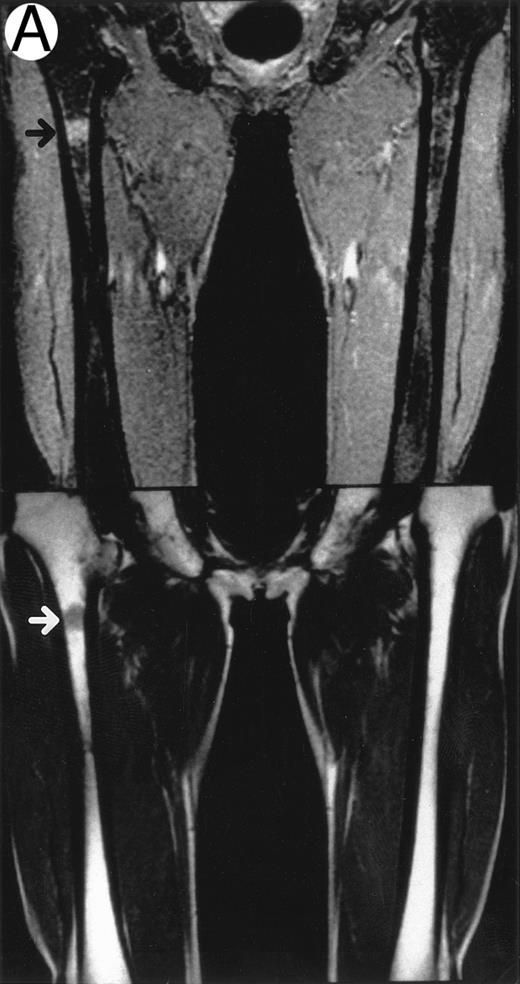 Fig. 1. Patterns observed on femoral marrow MRI. (A) Nodular (arrow), (B) scattered, and (C) uniform. Top: STIR images and, bottom: T1-weighted SE images.