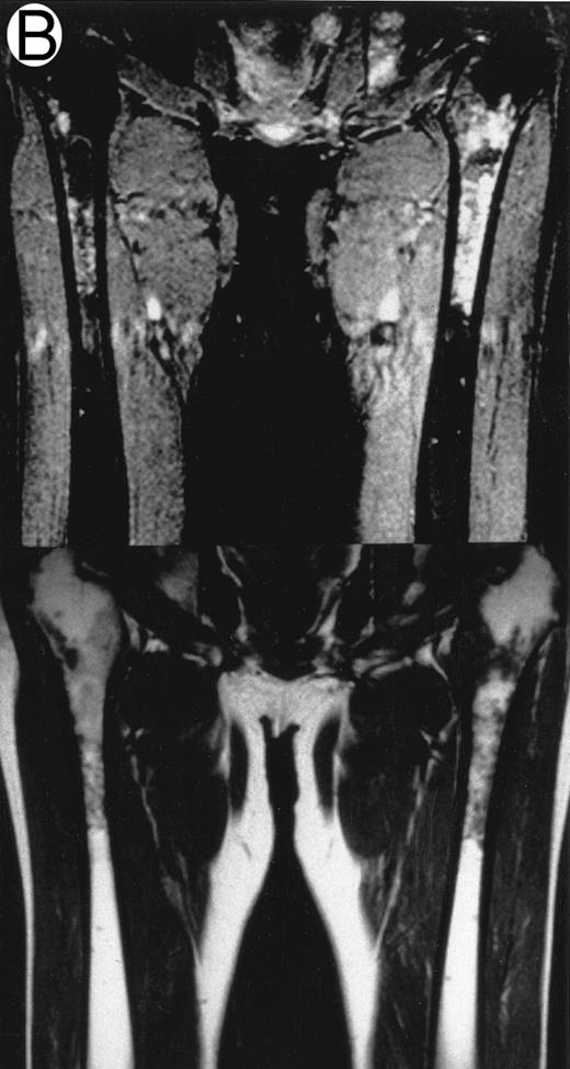 Fig. 1. Patterns observed on femoral marrow MRI. (A) Nodular (arrow), (B) scattered, and (C) uniform. Top: STIR images and, bottom: T1-weighted SE images.