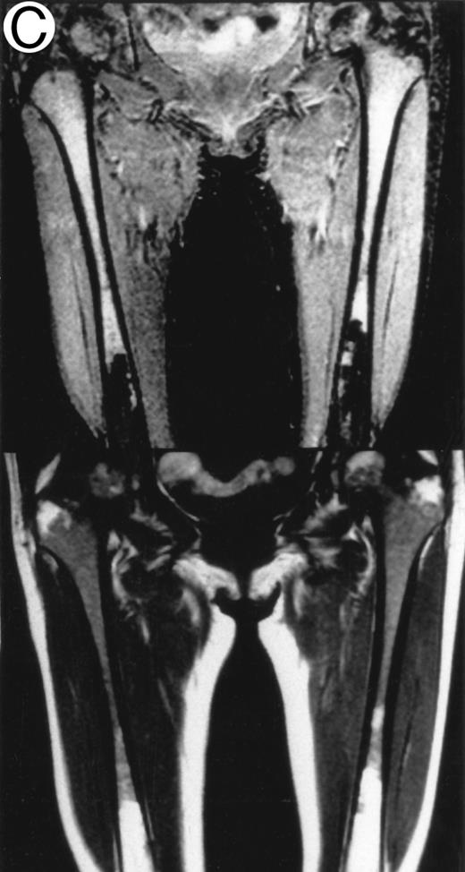 Fig. 1. Patterns observed on femoral marrow MRI. (A) Nodular (arrow), (B) scattered, and (C) uniform. Top: STIR images and, bottom: T1-weighted SE images.
