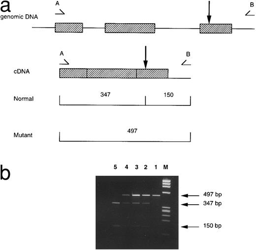 Fig. 1. Detection of the β-codon 121 G-T mutation by restriction analysis. (a) A 497-bp fragment of β cDNA is amplified by the primers A (5′-TGA GGA GAA GTC TGC CGT TAC-3′ ) and B (5′-CCC CAG TTT AGT AGT TGG ACT TA-3′ ). The EcoRI restriction site is indicated by the arrow; this is abolished by the β-codon 121 mutation. EcoRI digestion produces 2 fragments of 347 and 150 bp from the normal allele, and a single uncut 497-bp fragment from the mutant allele. (b) Ethidium bromide–stained 2% agarose gels of electrophoresed EcoRI-digested β cDNA. The lanes are represented by M:ΦX174 RF DNA/HaeIII marker; 1, Uncut fragment; 2, case no. 2; 3, case no. 1; 4, positive control for codon 121 G-T; 5, normal control.