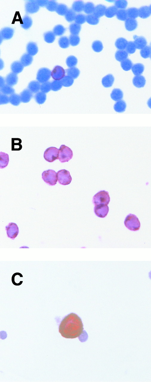 Fig. 2. Detection of breast cancer cells. CD34-selected cells were either stained with a CD3 MoAb (A), CD34 (B), or MoAb A45 anti-pancytokeratin (C). One CD3+ T cell can be detected in (A). All cells within the magnification field are CD34+ (B). Using pancytokeratin antibody A45, a breast cancer cell can be recognized in (C).