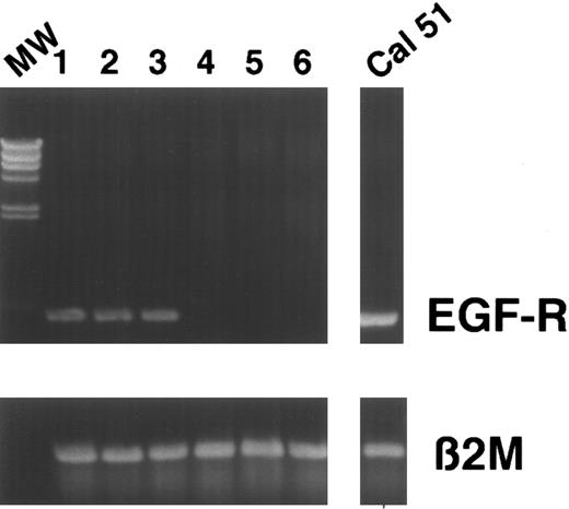 Fig. 3. PCR before and after CD34 selection. Cells were analyzed for EGF-R expression before and after CD34 selection. Results from several patients are depicted. Lanes 1, 3, and 5, expression of EGF-R in LP. Lanes 2, 4, and 6, EGF-R expression in CD34+ fractions. Lanes 1 and 2, patient no. 6 first induction cycle. Lanes 3 and 4, patient no. 12 first analysis. Lanes 5 and 6, patient no. 12 second induction cycle. MW, molecular weight marker. Breast cancer cell line Cal 51 was used as positive control: β2-microglobulin served as a control.