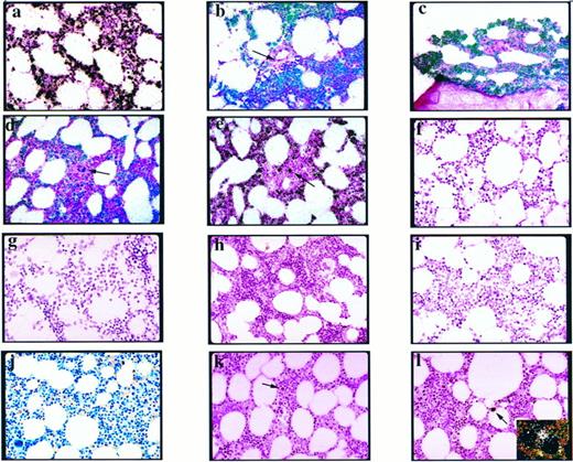 Fig. 1. Autoradiograms of BM biopsy specimens from HAM/TSP patients and normal, uninfected controls following PCR/ISH and ISH (hematoxylin and eosin counterstain, which stains nuclei purple and cytoplasm pink) (all photomicrographs are original magnification ×400). (a) PCR/ISH of HTLV-I-tax DNA in a BM autopsy specimen from patient 1. Extensive HTLV-I-tax DNA signal (brightfield microscopy, silver grains appear black). (b) PCR/ISH of HTLV-I-tax DNA in a BM biopsy specimen from patient 2. Extensive HTLV-I-tax DNA signal present (combined epiflourescence and transillumination, silver grains appear green above purple, hematoxylin-stained cells); however, there is minimal signal in endothelial cells surrounding blood vessels (arrow). (c) PCR/ISH of HTLV-I-tax DNA in a BM biopsy specimen from patient 3. Extensive HTLV-I-tax DNA signal present. (d) PCR/ISH of HTLV-I-tax DNA from an HAM/TSP patient, showing minimal signal around a megakaryocyte (arrow). (e) PCR/ISH of HTLV-I-tax DNA from an HAM/TSP patient, showing minimal signal of mature red blood cells surrounding a positive cell (arrow). (f ) PCR/ISH using HTLV-I-tax DNA specific primers plus Taq polymerase, after detection of the HTLV-I-tax–amplified product with a heterologous probe. There is no positive signal. (g) PCR/ISH of HTLV-I-tax DNA in a BM biopsy specimen of an uninfected, normal patient. There are no positive cells. (h and i) PCR/ISH of HTLV-I-tax DNA of the BM biopsy of patient 1, excluding Taq polymerase (h) or HTLV-I-tax–specific primers (i) from the PCR cocktail, and detection of the amplified product with the HTLV-I-tax probe. No positive cells. (j) Modified Giemsa (Lennert) stain of a representative field of BM biopsy specimen from an HAM/TSP patient showing normal hematologic morphology. (k) ISH for HTLV-I-tax DNA. There are no positive cells and no nonspecific probe binding to eosinophils (arrow). (l) ISH for HTLV-I-tax RNA in a BM biopsy specimen of an HAM/TSP patient. A single positive cell (arrow) is present. (Inset) Darkfield microscopy of same cell showing white silver grains above cell nucleus.