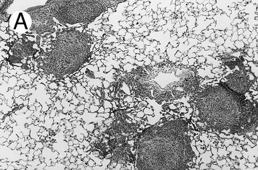 Fig. 3. Pulmonary findings 17 to 21 days after intratracheal instillation of A fumigatus conidia in X-CGD mice. Lung tissue was obtained 17 to 21 days after intratracheal challenge with 150 to 500 A fumigatus conidia, and stained with hematoxylin and eosin (A and C) or Grocott methamine silver (B). Representative photomicrographs obtained from three different mice are shown (original magnification × 100). (A) Untransplanted X-CGD mouse. Granulomatous microabscesses are seen, with occasional giant cells. (B) Untransplanted X-CGD mouse. Large inflammatory nodules with a central collection of neutrophils and numerous hyphae are seen. (C) X-CGD mouse transplanted with marrow transduced with the high-titer MSCV-m91Neo retrovirus. Occasional mononuclear cells in perivascular spaces and alveoli are seen, along with macrophages containing colloidal carbon (arrows) that was administered with the conidia to mark the site of delivery.