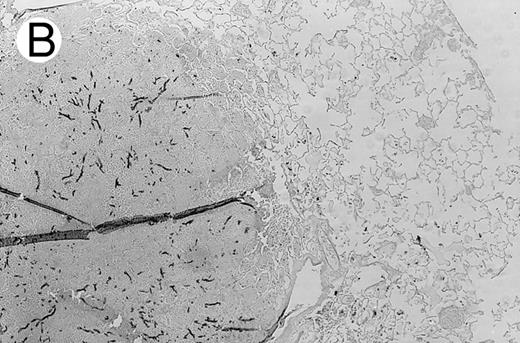 Fig. 3. Pulmonary findings 17 to 21 days after intratracheal instillation of A fumigatus conidia in X-CGD mice. Lung tissue was obtained 17 to 21 days after intratracheal challenge with 150 to 500 A fumigatus conidia, and stained with hematoxylin and eosin (A and C) or Grocott methamine silver (B). Representative photomicrographs obtained from three different mice are shown (original magnification × 100). (A) Untransplanted X-CGD mouse. Granulomatous microabscesses are seen, with occasional giant cells. (B) Untransplanted X-CGD mouse. Large inflammatory nodules with a central collection of neutrophils and numerous hyphae are seen. (C) X-CGD mouse transplanted with marrow transduced with the high-titer MSCV-m91Neo retrovirus. Occasional mononuclear cells in perivascular spaces and alveoli are seen, along with macrophages containing colloidal carbon (arrows) that was administered with the conidia to mark the site of delivery.