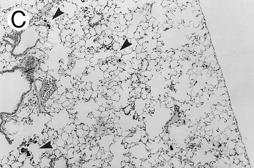 Fig. 3. Pulmonary findings 17 to 21 days after intratracheal instillation of A fumigatus conidia in X-CGD mice. Lung tissue was obtained 17 to 21 days after intratracheal challenge with 150 to 500 A fumigatus conidia, and stained with hematoxylin and eosin (A and C) or Grocott methamine silver (B). Representative photomicrographs obtained from three different mice are shown (original magnification × 100). (A) Untransplanted X-CGD mouse. Granulomatous microabscesses are seen, with occasional giant cells. (B) Untransplanted X-CGD mouse. Large inflammatory nodules with a central collection of neutrophils and numerous hyphae are seen. (C) X-CGD mouse transplanted with marrow transduced with the high-titer MSCV-m91Neo retrovirus. Occasional mononuclear cells in perivascular spaces and alveoli are seen, along with macrophages containing colloidal carbon (arrows) that was administered with the conidia to mark the site of delivery.