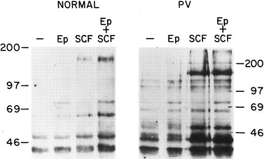 Fig. 1. Protein tyrosine phosphorylation in normal and PV ECFC after incubation with EP or SCF. Day-8 cells were incubated at 37°C with medium, rhEP at 20 U/mL, rhSCF at 100 ng/mL, or rhEP plus rhSCF for 10 minutes. The cells were then lysed and immunoprecipitated with anti-pTyr antibody for SDS-PAGE. -P h o s p h o t y r o s i n e - c o n t a i n i n g -proteins were identified by immunoblotting with anti-pTyr antibody. The purity of the ECFC was 74% ± 5% (normal) and 77% ± 4% (PV).