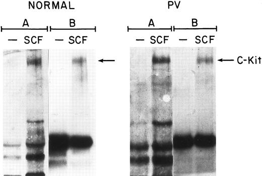 Fig. 3. SCF-induced tyrosine phosphorylation of c-kit in normal and PV ECFC. Day-8 cells were incubated at 37°C for 10 minutes in medium or in medium with rhSCF at 100 ng/mL. The cells were then lysed and immunoprecipitated with anti-pTyr antibody. Western blotting was performed with anti-pTyr antibody (A) and the immunoblots were reprobed with antibody to c-kit (B). The purity of the ECFC was 69% ± 12% (normal) and 77% ± 10% (PV).