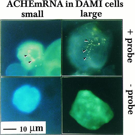 Fig. 2. Nuclear association of ACHEmRNA in DAMI cells. High resolution in situ hybridization was performed on cells in suspension using a DIG-labeled cRNA probe. Note that the yellow fluorescent signal (marked by arrows in the top panel) appeared in the presence of probe around multiple lobes in both small (left-hand side) and large MK (right-hand side) and was less pronounced in the cytoplasm, particularly in large cells. The absence of signal in cells treated similarly, but with no probe in the hybridization solution (bottom panel), demonstrated that these fluorogenic signals reflect cellular mRNA.
