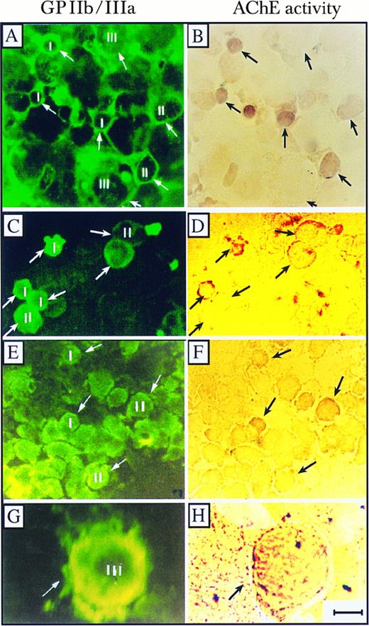 Fig. 6. AChE activity in normal and abnormal BM MK. Presented is cytochemical staining of AChE activity (right) and immunochemical staining with GPIIb/IIIa antibodies (left) of normal, normal TPO-expanded, and ITP BM cells. (A and B) Normal BM grown ex vivo in the presence of TPO; (C and D) normal BM cells; and (E and H) ITP BM cells. Small (I, diameter < 10 μm), intermediate (II, diameter 10 to 25 μm), and large (III, diameter < 25 μm) MK are marked. Note the pronounced staining of AChE activity in small megakaryoblasts and the gradual decrease in AChE activities from cells at stage I to cells at stages II and III towards nonproliferating MK in the normal BM MK and the visible activity staining in a representative mature stage III MK in BM from an ITP patient (G and H). Pictures are representative of one of three tested normal, one of three tested ITP preparations, and one of five normal TPO-expanded BM cultures. Size bar = 10 μm.