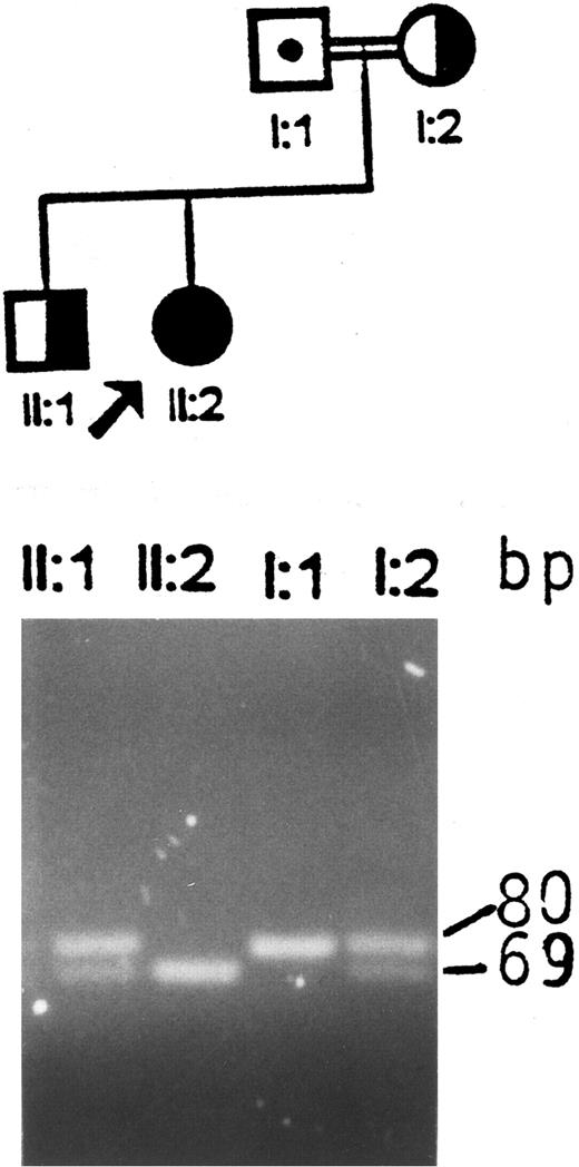 Fig. 1. Analysis of the I-J1 mutation in the proband and her immediate relatives. An apparent 11-bp deletion is seen in the PCR product of the proband, ie, a 69-bp fragment instead of the normal 80-bp fragment. The mother and the brother are heterozygous and have both 69- and 80-bp fragments. The father, who is an obligate carrier, shows only the 80-bp fragment, which is consistent with a normal genotype.