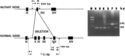 Fig. 6. A diagnostic PCR simultaneously using 3 primers for detection of the I-J2 mutation. F1 and R primers yield a 340-bp fragment only in DNA of a chromosome bearing the mutation as in a homozygous patient (P). In normal DNA (N), no amplification occurs due to the large distance between the primers (<11 kb). F2 and R primers yield a 190-bp fragment only in normal DNA, with no amplification occurring in mutant DNA because F2 is located within the deletion (P). In two hetrozygotes (H), both 190- and 340-bp fragments are demonstrable.