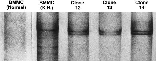 Fig. 3. Single-strand conformation polymorphism analysis of TCR Vβ21 cDNA amplified with the PCR. The cDNA from BMMC of a normal individual, BMMC of the patient, and the three Vβ21+ T-cell clones were amplified with the PCR, using a primer specific to Vβ21 and a Cβ primer. The amplified products were heat-denatured in a formamide solution and electrophoresed on an 8% polyacrylamide gel. The DNA was visualized by silver staining.