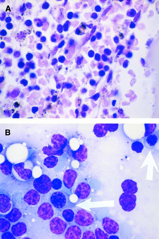Response to cyclosporin in pure red blood cell aplasia. A 54-year-old man has had acquired pure red blood cell aplasia associated with B-cell chronic lymphocytic leukemia since 1994. At diagnosis, the Direct Antiglobulin Test was negative. In May 1996, while receiving prednisolone (70 mg/d), his reticulocyte count was 7.1 × 109/L (reference range, 20 to 80 × 109/L); his hemoglobin level varied from 5.6 to 6.2 g/dL before red blood cell transfusions that he required every 1 to 2 weeks; his platelet count was 133 × 109/L; his leukocytes were 22.7 × 109/L, with a lymphocytosis of 15.9 × 109/L; and he had a normal granulocyte count of 5.6 × 109/L. The bone marrow showed severe erythroid hypoplasia, a reduced number of megakaryocytes, a normal proportion of granulocyte precursors, and marked lymphocytic infiltration (A). Two weeks after starting cyclosporin A at 250 mg twice daily, the drug concentration in whole blood was 155 μg/L and his reticulocyte count had increased to 145 × 109/L. By 4 weeks, the hemoglobin level had increased to 11.4 g/dL without red blood cell transfusion and the prednisolone decreased to 5 mg/d. Repeat marrow biopsy 3 weeks after initiating cyclosporin therapy showed an increased number of erythroid precursor cells (arrows in B). (Courtesy of I.E. Okpala, MRCPath, FWACP, Bronglais General Hospital, Aberystwyth, UK.)