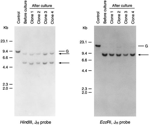 Fig. 4. Leukemic lymphoblasts after culture retain Ig gene rearrangement in the same configuration determined before culture. Shown is the Southern blot analysis of Ig gene rearrangements in leukemic cells from case no. 3 obtained before culture and after 7 months of culture on stroma. Four clones derived in vitro from single leukemic cells were studied. DNA was digested with the restriction enzymes indicated and probed with a JH probe. Arrows point to the rearranged bands; G corresponds to the germline band. The KB epidermoid carcinoma cell line, which has Ig genes in germline configuration, was used as a control. The faint germline bands seen in some of the clones after culture are probably derived from residual stromal cells.