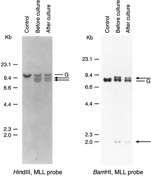 Fig. 6. MLL gene rearrangements are retained in cultured leukemic lymphoblasts. DNA was extracted from cells of case no. 1 before culture and from a clone initiated by a single leukemic cell after 3 months of culture. DNA was digested with the restriction enzymes indicated and probed with an MLL cDNA probe. Arrows indicate the rearranged bands; G corresponds to the germline bands. The KB epidermoid carcinoma line, which has normal MLL alleles, was used as a control.