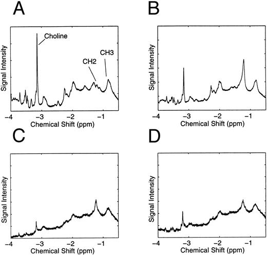 Fig. 5. Spectral changes associated with apoptotic Jurkat cultures with different therapies. The 1H NMR spectra (at 400 MHz) corresponding to the Jurkat cultures before lipid extraction and TLC shown in Fig 6. (A) Control culture. The resonance peaks for choline, CH2 , and CH3 protons are shown. (B) Jurkat cells treated with 200 ng/mL of doxorubicin for 24 hours. (C) Jurkat cells deprived of serum for 3 days. (D) Jurkat cells treated with 200 ng/mL of CH 11 IgM Fas antibody for 48 hours. The CH2/CH3 signal intensity ratio, the percentages of apoptotic cells seen by nuclear morphologic analysis, and FITC-annexin V flow cytometric analysis for each culture were as follows: control (0.29, 5%, and 9.8%, respectively), doxorubicin-treated (2.55, 51%, and 47%, respectively), serum-starved (1.82, 54%, and 46.8%, respectively), and Fas antibody (1.63, 69%, and 71%, respectively).