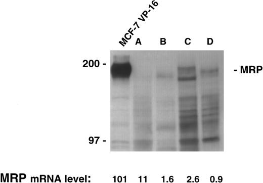 Fig. 3. MRP expression as measured by immunoblotting in the cell line MCF-7 VP-16 and four patient samples. Protein was harvested from four patient samples where sufficient material was available. A total of 200 μg of protein from the four patient samples and 100 μg of protein from MCF-7 VP-16 cells was analyzed by immunoblotting as described in the Materials and Methods section.
