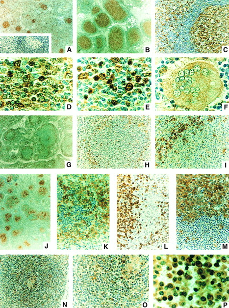 Fig. 2. CPP32 immunostaining of normal and reactive lymph nodes and in B-cell malignancies. Some representative examples of the CPP32 immunostaining results are presented. (A) Normal node showing small secondary follicles with strong CPP32 immunostaining in germinal centers (GC) surrounded by a cuff of mantle zone (MZ) cells lacking CPP32 immunoreactivity and scattered cells in the interfollicular regions (IF ) with CPP32 immunopositivity (original magnification ×40). Inset shows same sample in which the CPP32 antiserum was first preadsorbed with CPP32 protein. (B and C) RFH (original magnification ×40 and ×200, respectively), showing enlarged follicles with strongly CPP32 immunopositive GCs, surrounding cuff of CPP32-negative MZ lymphocytes, and scattered cells in IF region with strong CPP32 immunoreactivity. In (C), the GC is located towards the right and the IF zone to the left. (D and E) Higher-power (original magnification ×1,000) views of CPP32-immunostaining in GC and IF zone, respectively, from a node with RFH. CPP32 immunostaining is found in cytosol or both cytosol and nucleus of some lymphocytes, particularly large noncleaved, transformed (“activated”) lymphocytes in the IF zone as well as in the plasma cells. Small round lymphocytes in the IF region are typically CPP32 negative or only weakly immunostained. In (F ), a multinucleated giant cell with moderate intensity cytosolic CPP32 immunostaining is shown, surrounded by mostly CPP32-negative small lymphocytes, in a case of RFH (original magnification ×1,000). (G through I) A case of FSC lymphoma at original magnification ×40, ×200, and ×400, respectively, showing CPP32-negative small cleaved cells filling centers of follicles, with residual strongly CPP32-positive normal transformed (activated) lymphocytes and plasma cells surrounding the follicles. In (I), the center of the follicle is oriented towards the right/bottom corner and a band of CPP32-positive normal cells located at the periphery of the follicle is shown in upper-left corner. (J through L) A case of FLCL immunostained for CPP32 (J and K) (original magnification ×40 and ×400) or Bcl-2 (L) (original magnification ×400) showing mixtures of large cells with strong cytosolic CPP32 immunostaining and small cleaved cells with little or no CPP32 immunoreactivity. The small cleaved cells, however, stain strongly for Bcl-2 in their cytosol (L). (M) DLCL showing large neoplastic cells with strong, mostly cytosolic CPP32 immunoreactivity (top) at the border with residual normal small, round lymphocytes (bottom) still present in the node (original magnification ×400). (N and O) MCL showing remnant of normal GC (located at center in N and in upper-right corner in O) with moderately CPP32-positive histiocytes and occasional adjacent large noncleaved cells with strong CPP32 immunoreactivity, surrounded by MCL cells that mostly contain no or only weak CPP32 immunoreactivity (original magnification ×200 and ×400). (P) Plasmacytoma, showing plasmacytoid cells with moderate to strong intensity CPP32 immunoreactivity, mostly in the cytosol (original magnification ×1,000). Red cells are immunonegative.