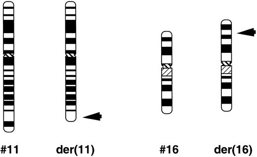 Fig. 1. Schematic partial karyotype of t(11; 16) (q23; p13). The normal chromosomes of nos. 11 and 16 are on the left in each pair. Arrowheads indicate the breakpoints in the translocation chromosome on the right.