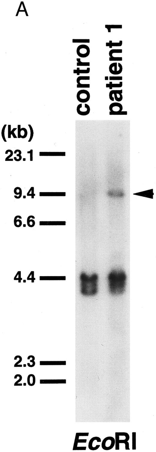 Fig. 3. (A) Southern blot of DNA digested with EcoRI and probed with the 0.9-kb fragment of the MLL gene. Control, peripheral lymphocytes. Patient 1 exhibited a rearranged band (arrowhead) with this probe. (B) Northern blot of RNAs from patient 1 and a control leukemic cell line (BALM14) using a 0.5-kb CBP cDNA fragment as a probe. Patient 1 showed an abnormal transcript (arrowhead).