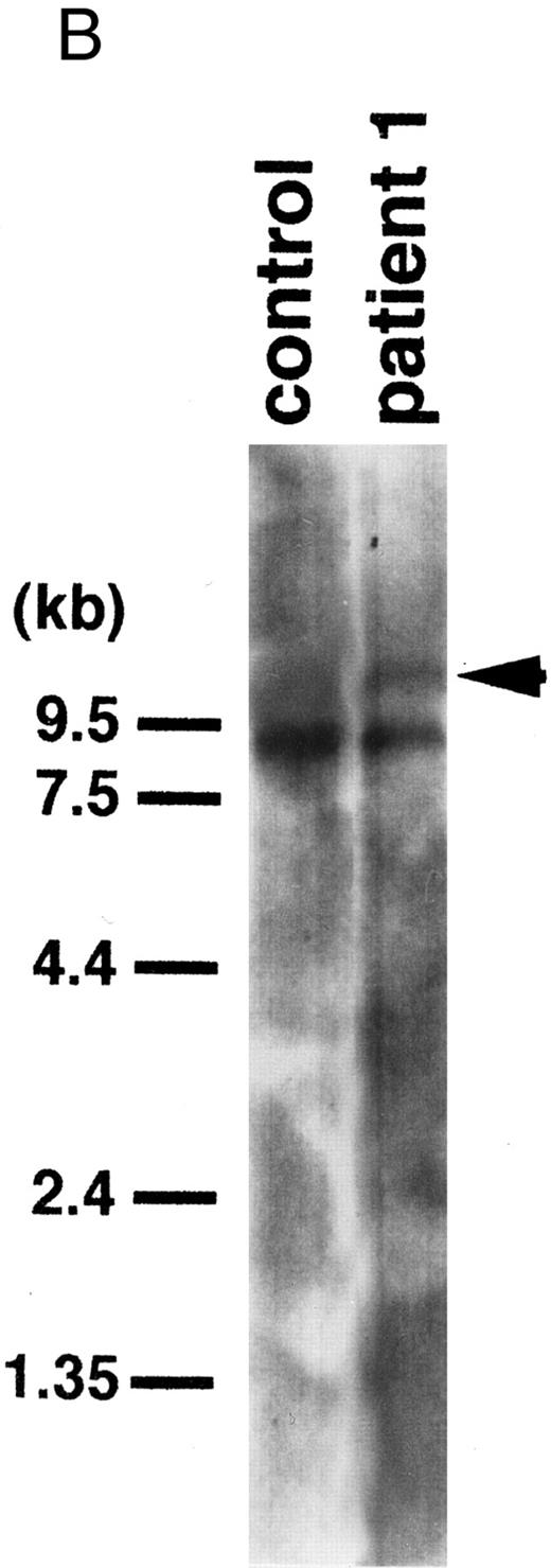 Fig. 3. (A) Southern blot of DNA digested with EcoRI and probed with the 0.9-kb fragment of the MLL gene. Control, peripheral lymphocytes. Patient 1 exhibited a rearranged band (arrowhead) with this probe. (B) Northern blot of RNAs from patient 1 and a control leukemic cell line (BALM14) using a 0.5-kb CBP cDNA fragment as a probe. Patient 1 showed an abnormal transcript (arrowhead).