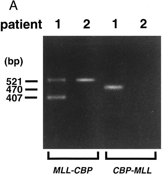 Fig. 4. (A) Identification of fusion transcripts by RT-PCR. Primers used were MLL-7S and CBP-1A (MLL-CBP), and CBP-2S and MLL-11A (CBP-MLL). (B) Partial sequences at the chimeric junctions from five cDNAs (MLL, longer and shorter fragments of MLL-CBP, CBP-MLL, and CBP). longer, longer fragment of 521 bp from patients 1 and 2; shorter, shorter fragment of 407 bp from patient 1. Vertical lines indicate the exon-exon junctions of each gene. Arrows indicate the fusion points of each cDNA.