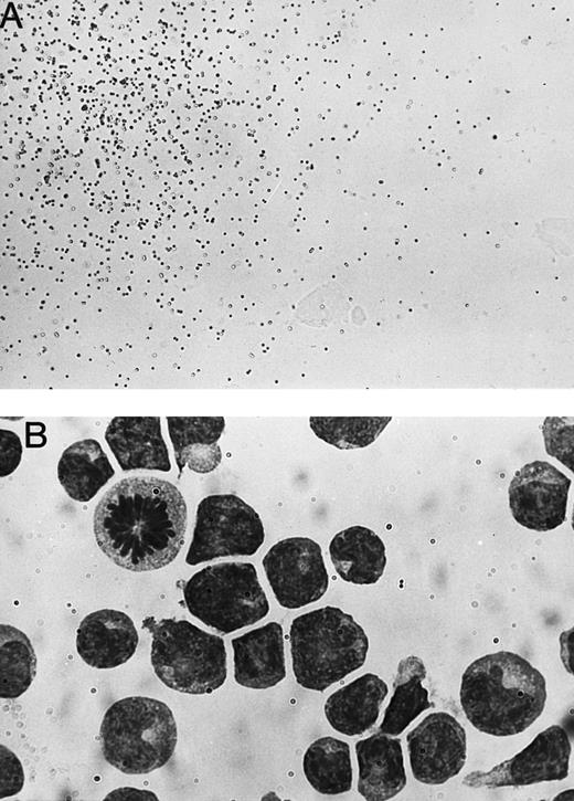 Fig. 1. Photomicrographs of a immature NK cell colony. (A) One quarter of a representative immature NK cell colony seen on an inverted microscope. Original magnification (OM) × 40. (B) A portion of a May-Grünwald Giemsa–stained smear of the colony. OM × 100.