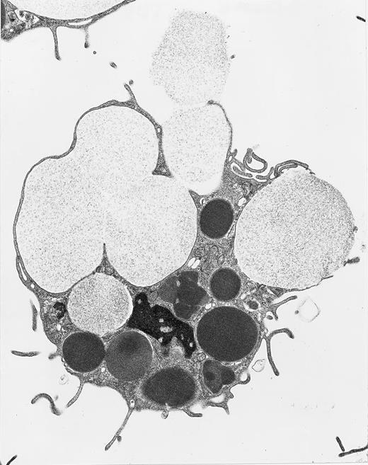 Peritoneal mast cell from a Beige rat undergoing anaphylactic degranulation of giant secretory granules. Swollen, less electron-dense secretory granules in the process of extrusion are enlarged beyond the giant, electron-dense cytoplasmic secretory granules not so involved. Original magnification × 12,000. (Courtesy of Ann M. Dvorak, MD, Department of Pathology, Beth Israel Hospital, Harvard Medical School, 330 Brookline Ave, Boston, MA 02215.)