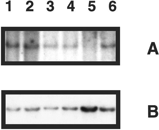 Fig. 1. Southern blot analysis of p16 gene deletion in five patient specimens. (A) DNA samples digested with EcoRI and hybridized with p16 exon 2 probe revealing a band of 4.3 kb for normal DNA only (lane 1), which is not present in 1 patient specimen (lane 5). (B) The same blot was rehybridized with a probe for the IL-2RB gene, demonstrating the presence of DNA in all lanes.
