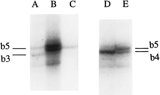Fig. 1. Autoradiography of the electrophoresis of PCR products after amplification of CA samples. A 6% polyacrylamide gel was used as described in Materials and Methods. (A) Sample heterozygous for alleles b3 and b5. (B) Sample heterozygous for the b4 and b5 alleles. (C) Sample homozygous for the b4 allele. (D) Sample homozygous for the b4 allele. (E) Sample heterozygous for the b4 and b5 alleles.
