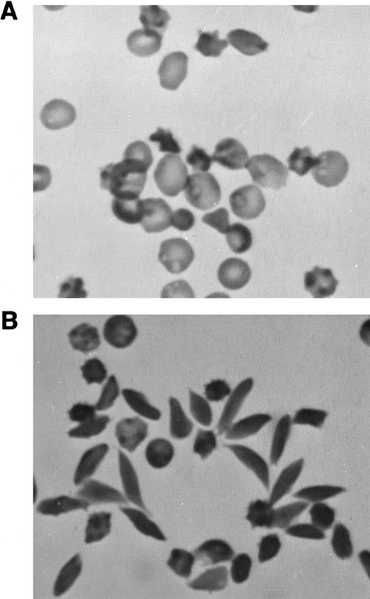 Fig. 2. Photomicrographs of blood from Tg58 × Tg98 mice. (A) Freshly drawn blood was transferred directly into 2.5% glutaraldehyde in 0.1 mol/L cacodylate buffer. In the peripheral blood, many RBCs (25% to 35%) were misshapen but very few had the classical looking shape of sickle cells. (B) Many elongated sickle cells with pointed ends (30% to 50%) developed when blood was deoxygenated in phosphate-buffered 1% Na2S2O5 . (Original magnification × 400.)