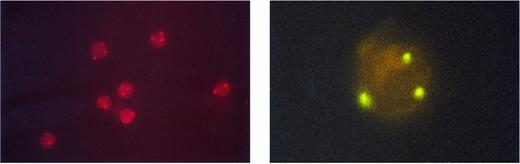Fig. 3. Unsorted peripheral blood cells after FISH with a chromosome 12-specific α satellite DNA probe conjugated to spectrum orange. Three fluorescent hybridization signals indicate trisomy 12; two signals represent diploid cells (left). The right side shows a sorted CD34+/38+ cell hybridized to a spectrum green labeled a chromosome 12-specific α satellite DNA probe. The three hybridization spots indicate trisomy 12 (right).