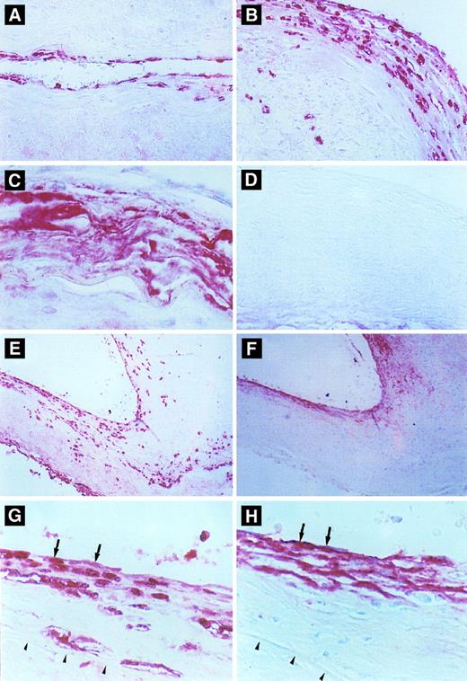 Fig. 6. Immunohistochemical detection of defensin in cerebral vessels. (A) Cerebral vessel with mild thickening of the intima due to atherosclerotic changes. Note focal immunostaining for defensin within the cytoplasm of endothelial cells and occasional intimal cells. (B) A more severely affected vessel with extensive endothelial cell and intimal staining for defensin and staining of occasional cells within the media. (C) An advanced atherosclerotic plaque with intense, diffuse immunostaining for defensin, predominantly in extracellular locations. (D) Atherosclerotic vessel incubated with control Ig. (E and F ) Comparison between staining for defensin (E) and Lp(a) (F ) in adjacent sections of an atherosclerotic cerebral vessel. In some portions of the vessel, defensin and Lp(a) are coexpressed in the endothelium and portions of the intima (left side), whereas in other regions the distribution of the two molecules differs slightly (right side). This slide is representative of the finding that Lp(a) was found in the absence of defensin predominantly in less cellular regions of the vessel wall, whereas staining for defensin was more focal and cell-associated and reached deeper into the intimal, media, and adventitia. (G) and (H) are adjacent sections taken from the margin of an atherosclerotic plaque. The internal elastic membrane is delineated by the arrows. Staining of several endothelial cells for both defensin and Lp(a) is shown by the arrows.