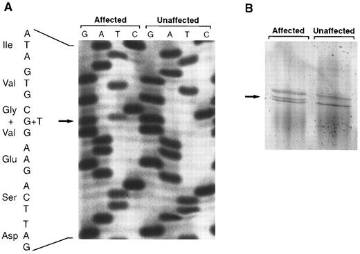 Fig. 2. (A) Identification of the Gly295Val mutation in exon X of PROS1 by single strand solid-phase sequencing. A section of the autoradiograph for an affected family member (reduced free protein S antigen level) and an unaffected relative (normal free protein S antigen level) is shown. The mutation was caused by a G to T transition (arrow). Specificity for PROS1 is evident, as the second base 3′ of the mutation is a guanine only; a difference between the PROS1 gene and the pseudogene has been reported at this position.20 (B) Detection of the Gly295Val mutation by SSCP. A fragment containing exon X of PROS1 was electrophoresed in a homogenous 20% polyacrylamide gel and stained with silver nitrate. The additional band seen in affected family members heterozygous for the Gly295Val mutation is indicated with an arrow.