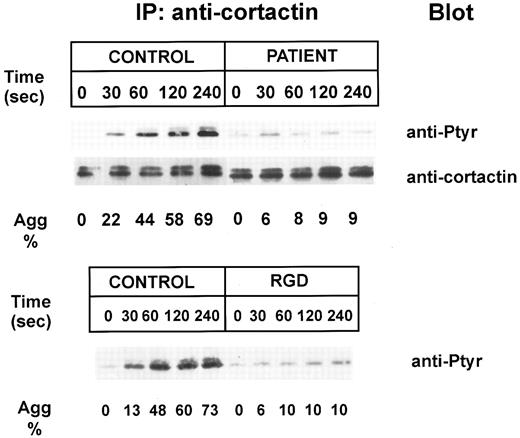 Fig. 3. Comparative kinetics of tyrosine phosphorylation of cortactin in control, thrombasthenic, and RGDS-treated platelets. Platelets from a control (CONTROL), the type II thrombasthenic patient (PATIENT) of Fig 1B (top panel), or control platelets incubated with 1 mmol/L RGDS peptide (RGDS) (lower panel) were activated with 0.05 U/mL thrombin, solubilized, and immunoprecipitated with an anticortactin antibody (IP: cortactin). Immunoprecipitated polypeptides were subjected to SDS-PAGE followed by Western blot analysis using an anti-Ptyr antibody (“anti-Ptyr” in the “Blot” column) or an anticortactin (“anticortactin” in the “Blot” column) to control for efficiency of cortactin immunoprecipitation (shown only for upper panel). Aggregation rates are indicated.