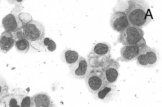 Fig. 8. CD437-mediated apoptosis in primary leukemia cells. Leukemic blasts were isolated as described in the Materials and Methods. Cells were exposed to 1 μmol/L CD437 for various periods of time and PARP cleavage was assessed as previously described. (A) Leukemic cells exposed only to vehicle for 48 hours. (B) Leukemic cells exposed to 1 μmol/L CD437 for 48 hours. (C) CD437-mediated PARP cleavage. Lanes 1 and 3, cells exposed to vehicle only for 24 and 48 hours, respectively. Lanes 2 and 4, cells exposed to 1 μmol/L CD437 for 24 and 48 hours, respectively.