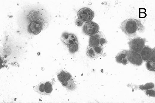 Fig. 8. CD437-mediated apoptosis in primary leukemia cells. Leukemic blasts were isolated as described in the Materials and Methods. Cells were exposed to 1 μmol/L CD437 for various periods of time and PARP cleavage was assessed as previously described. (A) Leukemic cells exposed only to vehicle for 48 hours. (B) Leukemic cells exposed to 1 μmol/L CD437 for 48 hours. (C) CD437-mediated PARP cleavage. Lanes 1 and 3, cells exposed to vehicle only for 24 and 48 hours, respectively. Lanes 2 and 4, cells exposed to 1 μmol/L CD437 for 24 and 48 hours, respectively.