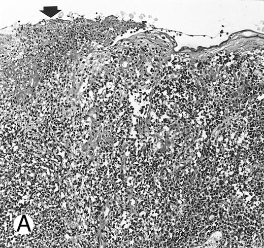 Fig. 1. Nasal-type NK/T-cell lymphoma presenting as nodular skin lesion (case no. 28). (A) The skin shows focal necrosis of the epidermis and ulceration (arrow). (B) The lymphoid infiltrate in the dermis shows angiocentricity, as evidenced of the higher density of cells in the expanded walls of the blood vessels (arrows).