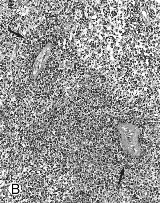 Fig. 1. Nasal-type NK/T-cell lymphoma presenting as nodular skin lesion (case no. 28). (A) The skin shows focal necrosis of the epidermis and ulceration (arrow). (B) The lymphoid infiltrate in the dermis shows angiocentricity, as evidenced of the higher density of cells in the expanded walls of the blood vessels (arrows).