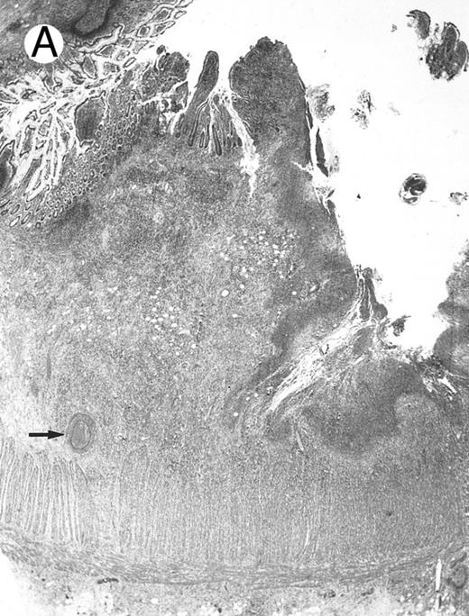 Fig. 2. Laryngeal nasal-type NK/T-cell lymphoma relapsing as perforation of the terminal ileum (case no. 33). (A) The small bowel mucosa shows extensive necrosis and ulceration in the right field. There is also transmural lymphomatous infiltration. Note the vascular occlusion by lymphoma (arrow). (B) Higher magnification shows large and medium-sized lymphoma cells with irregular nuclear contours. The chromatin is fairly dense.
