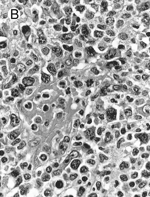 Fig. 2. Laryngeal nasal-type NK/T-cell lymphoma relapsing as perforation of the terminal ileum (case no. 33). (A) The small bowel mucosa shows extensive necrosis and ulceration in the right field. There is also transmural lymphomatous infiltration. Note the vascular occlusion by lymphoma (arrow). (B) Higher magnification shows large and medium-sized lymphoma cells with irregular nuclear contours. The chromatin is fairly dense.