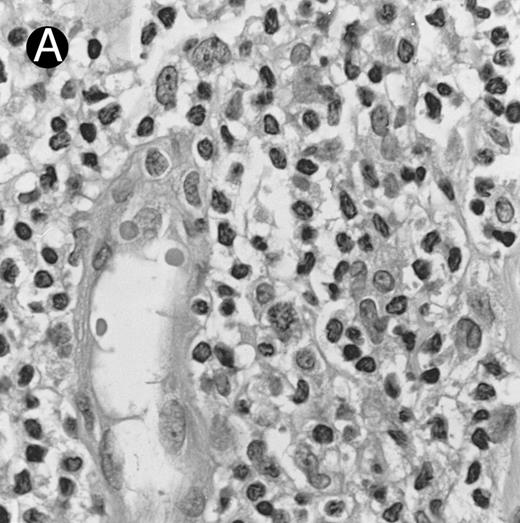 Fig. 3. Cutaneous nasal-type NK/T-cell lymphoma (case no. 34). (A) This biopsy was initially misinterpreted as vasculitic lesion because of the small size of the lymphoid cells and the minimal cellular atypia. (B) Large numbers of lymphoid cells in the skin show positive labeling for EBERs on in situ hybridization. The sweat gland in the left field is negative.